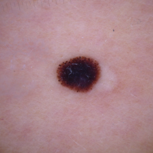 Dermoscopy image of a skin lesion