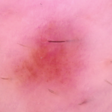 Dermoscopy image of a nevus
