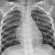 Chest X-ray