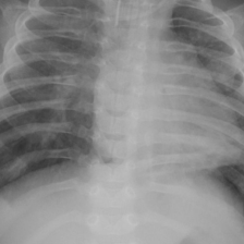 Chest X-ray with pneumonia