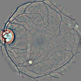 A retina scan, from Retinopathy